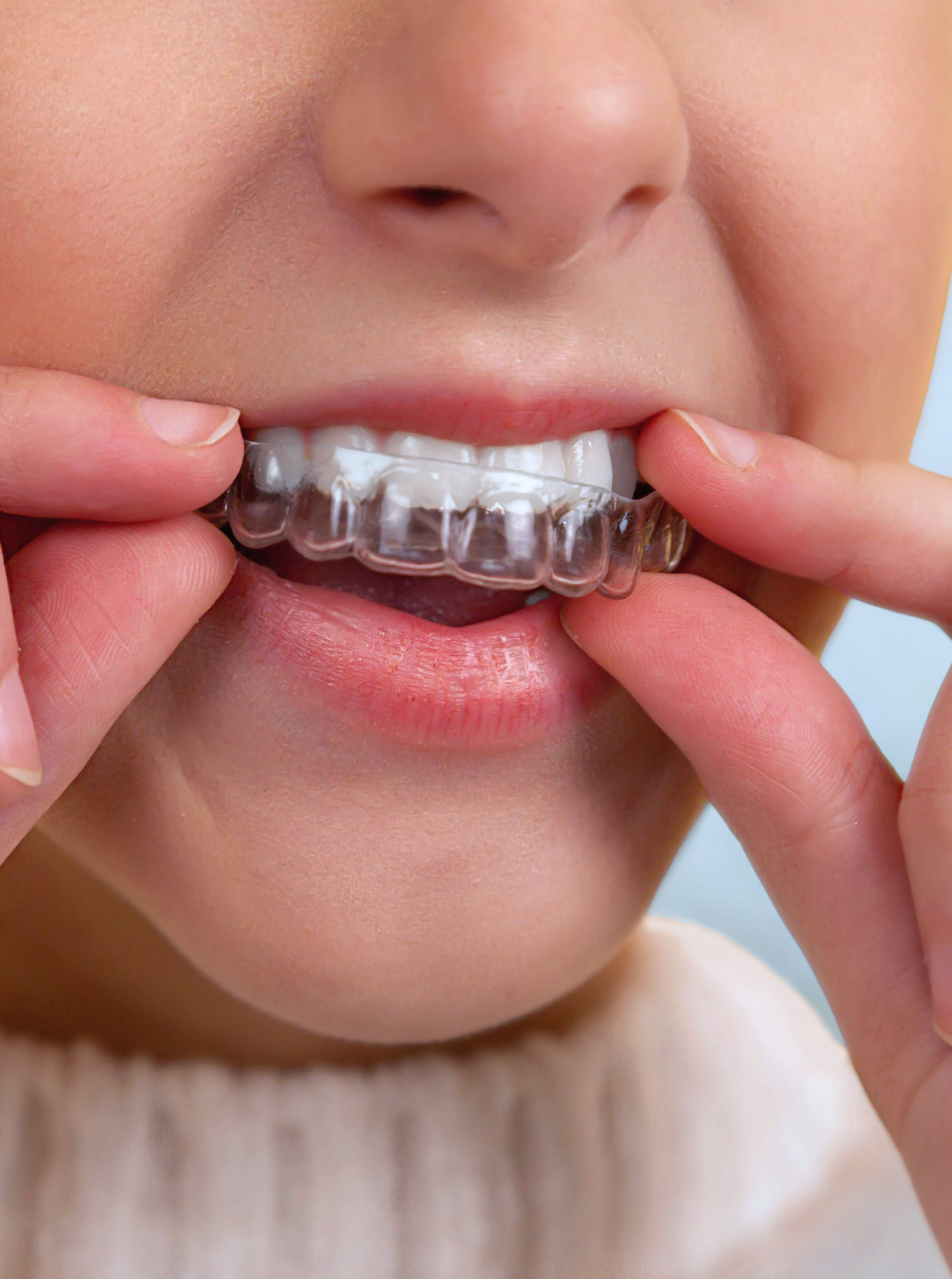 aligners (1)
