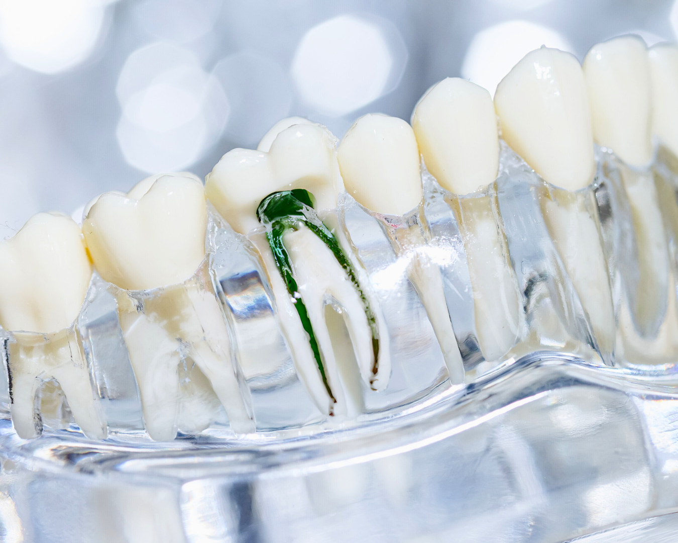 root canal treatment